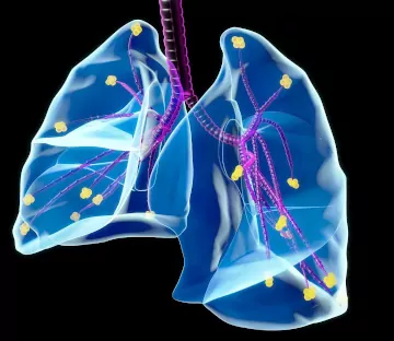 micronodulos pulmonares