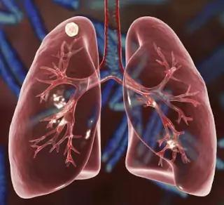 nodulos pulmonares