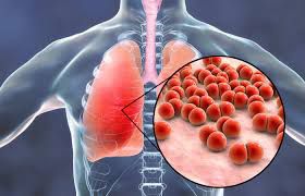 pneumonia