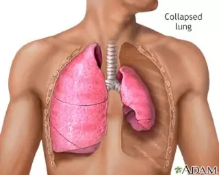 pneumotorax